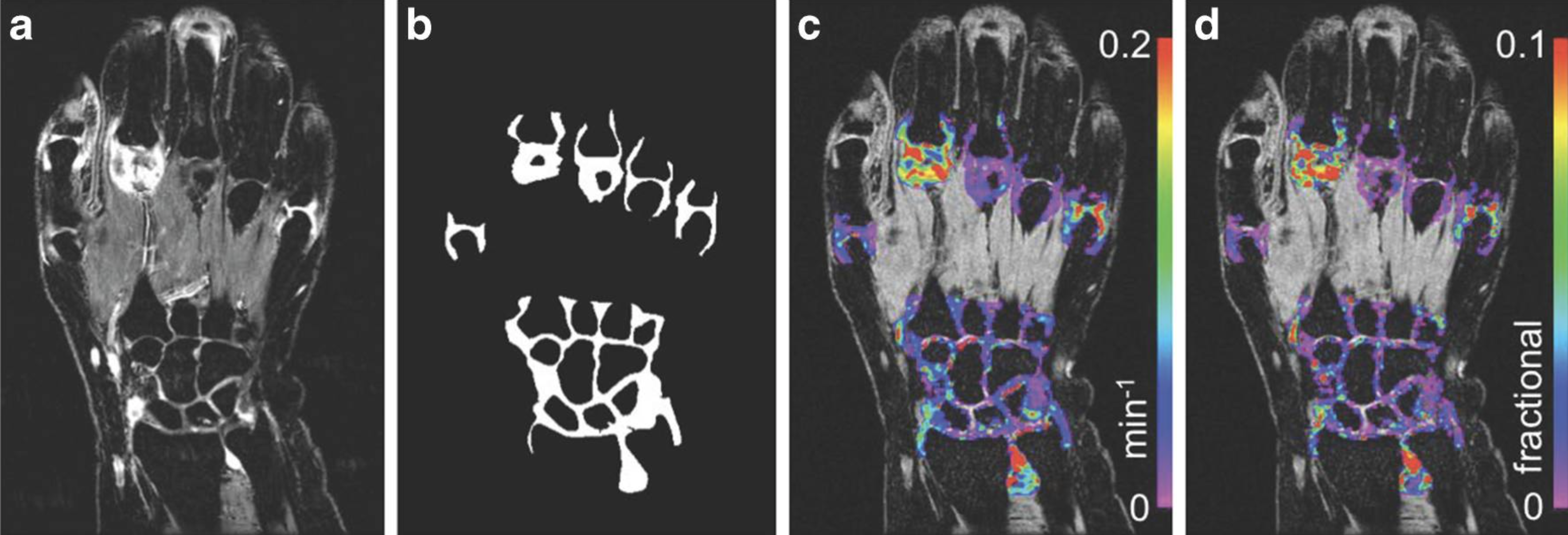 Anti-granulocyte-macrophage colony-stimulating factor antibody otilimab in patients with hand osteoarthritis: a phase 2a randomised trial